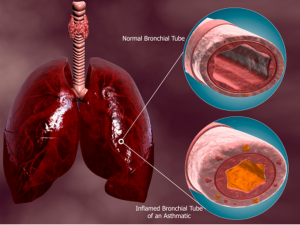 Colorado Allergy helps patients with COPD/Bronchitis