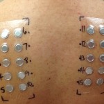 Colorado Allergy patch test