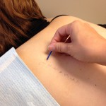 Colorado Allergy Scratch Testing