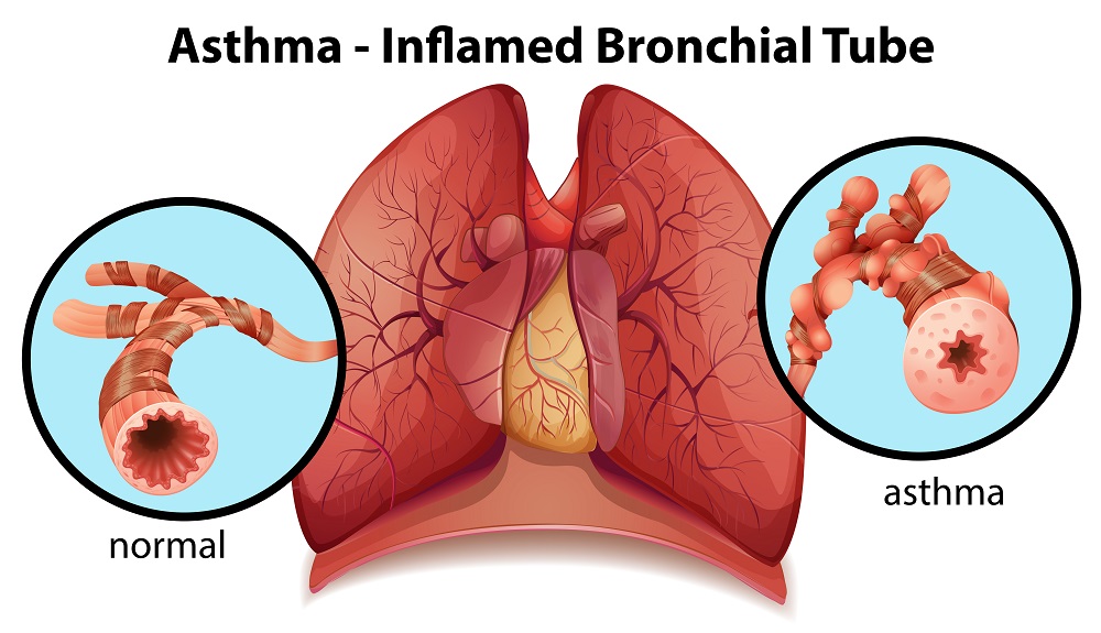 What Does Inflamed Lungs Look Like