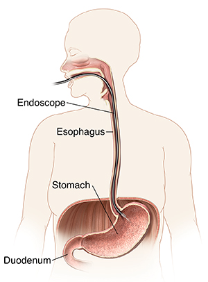EoE endoscopy
