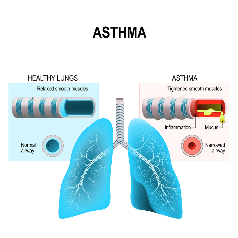 Is Allergic Asthma Chronic