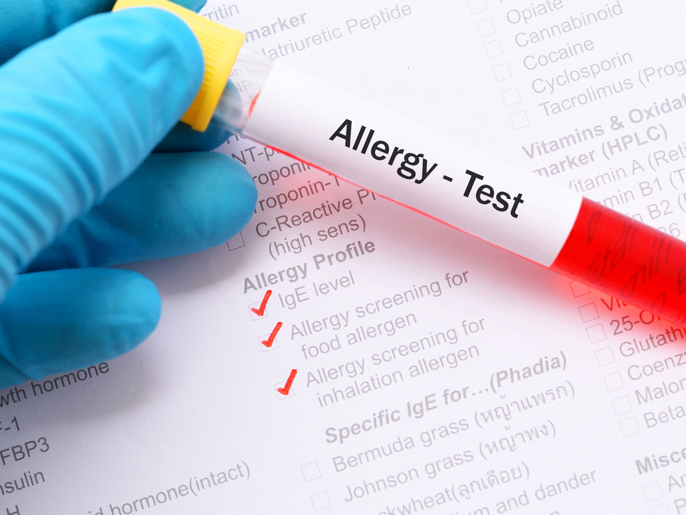 allergy testing near me nhs