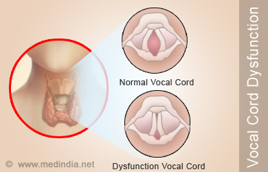 vocal cord dysfunction
